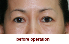 plastic-surgery-blepharoplasty